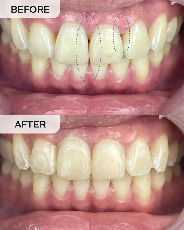 Pembaikan Black Triangle before and after result at Ivory Dental Kepong