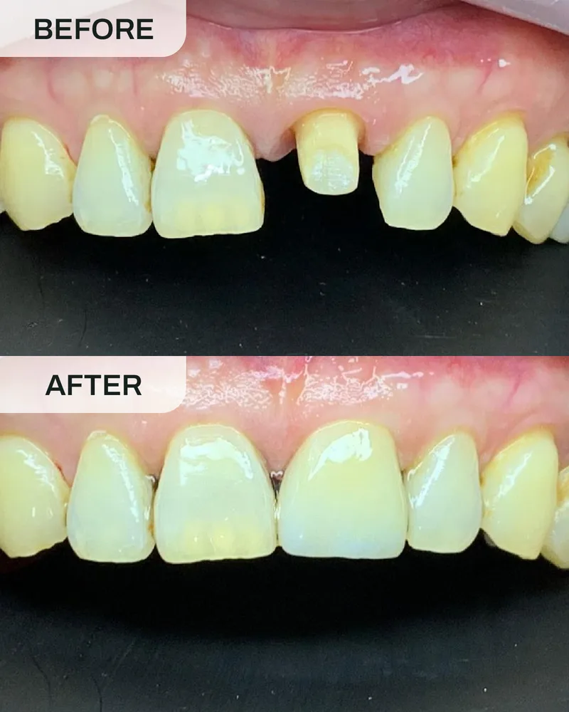 牙冠与牙桥前后对比,案例2,Ivory Dental 甲洞