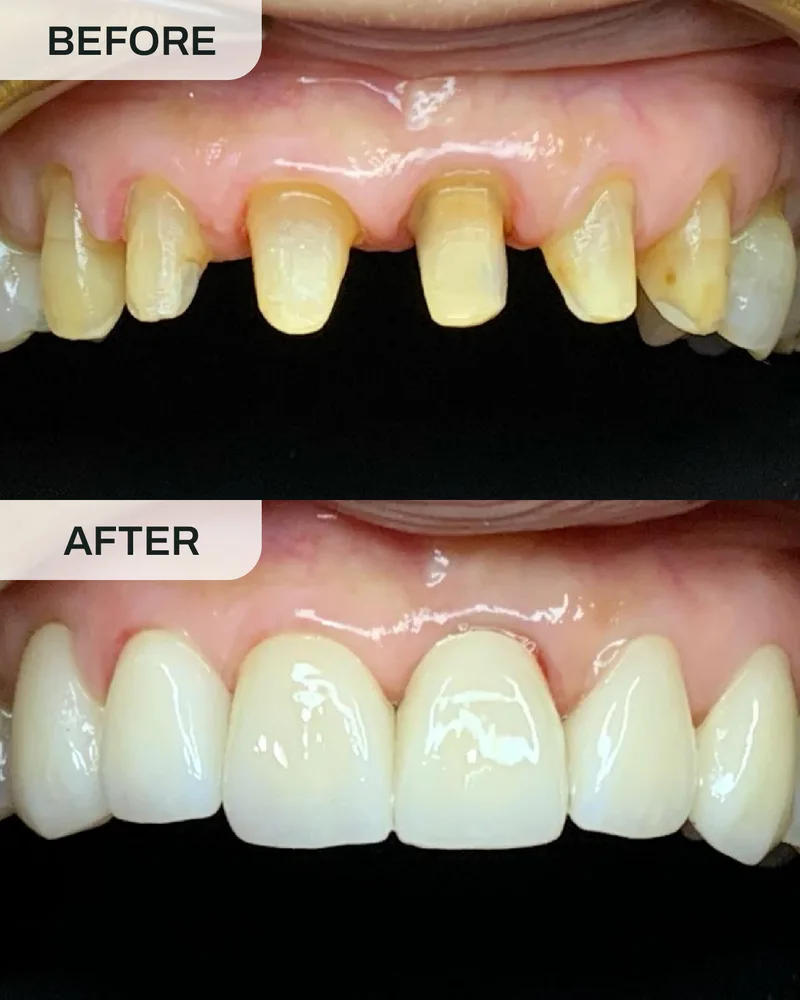 牙冠与牙桥前后对比,案例3,Ivory Dental 甲洞