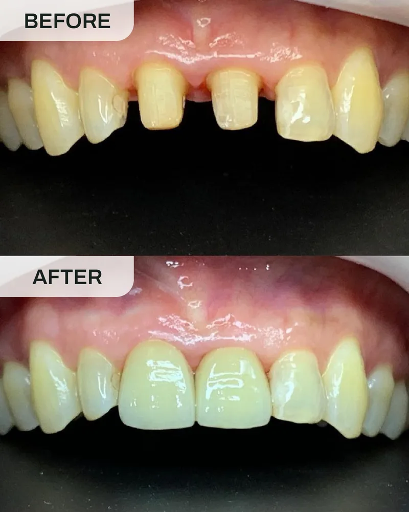 牙冠与牙桥前后对比,案例4,Ivory Dental 甲洞