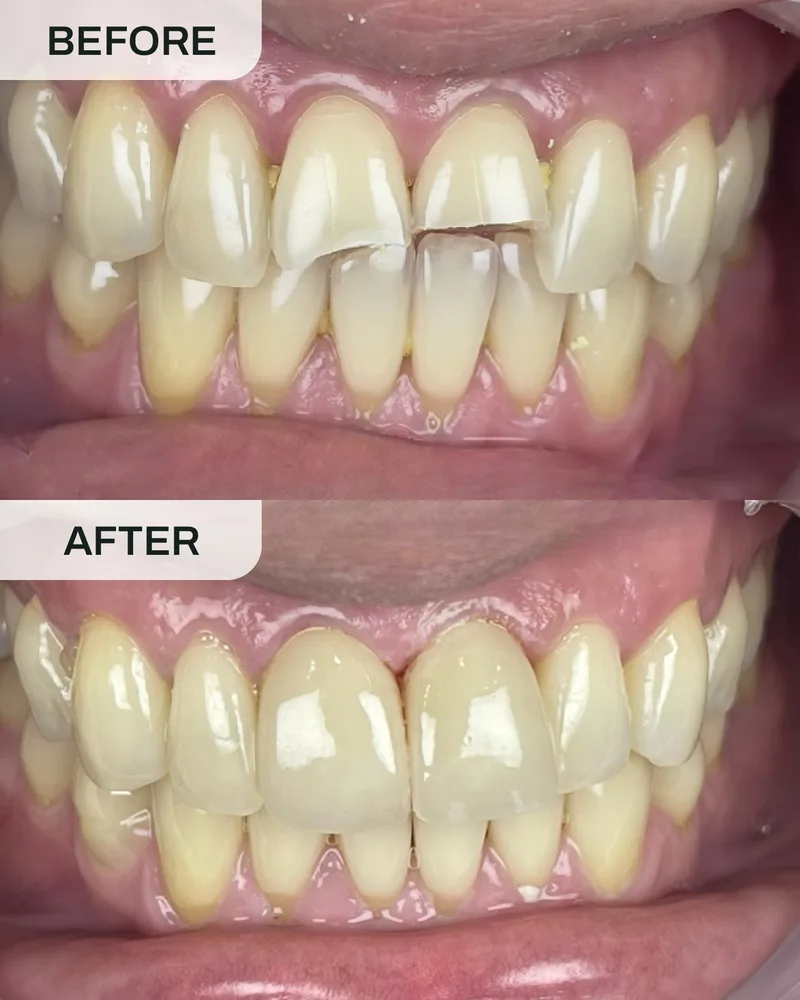 牙冠与牙桥前后对比,案例5,Ivory Dental 甲洞