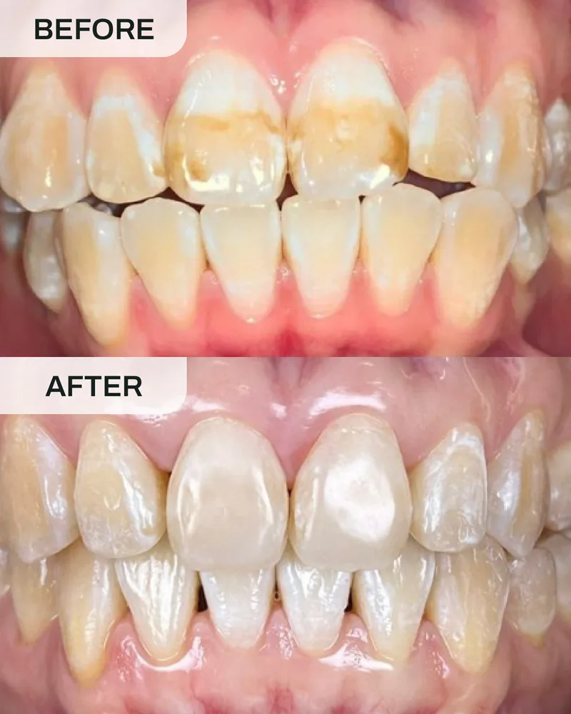 牙冠与牙桥前后对比,案例6,Ivory Dental 甲洞