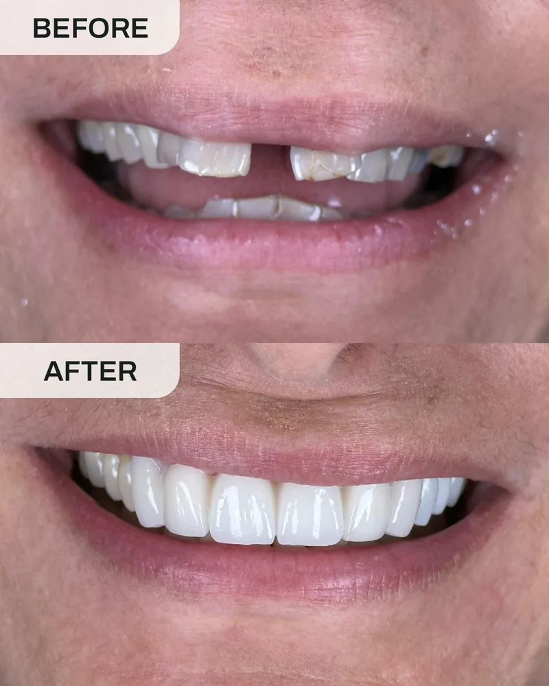 牙冠与牙桥前后对比,案例7,Ivory Dental 甲洞