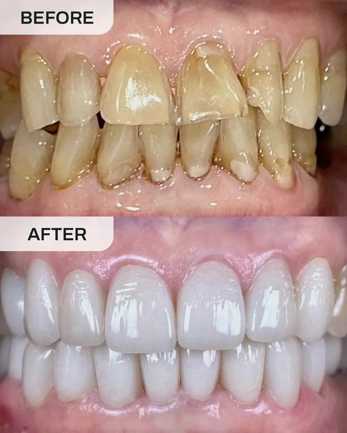 Mahkota Gigi before and after result at Ivory Dental Kepong