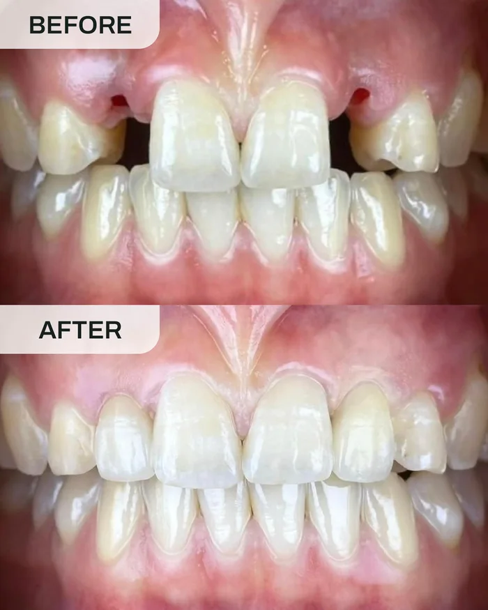 Implan Gigi before and after result at Ivory Dental Kepong