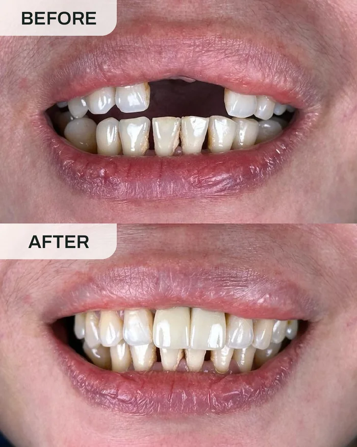 Implan Gigi before and after result at Ivory Dental Kepong