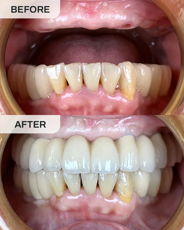 Implan Gigi before and after result at Ivory Dental Kepong