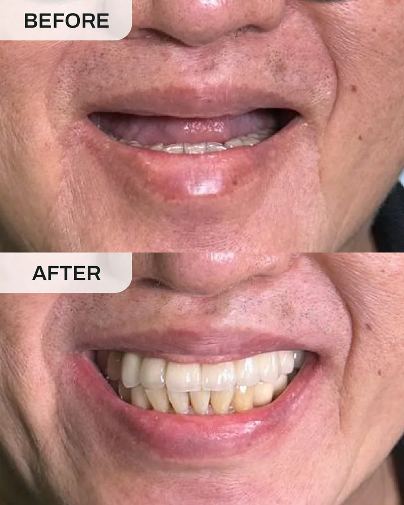 牙科植体前后对比,案例4,Ivory Dental 甲洞
