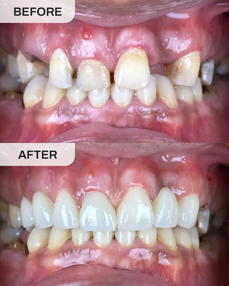 牙科植体前后对比,案例5,Ivory Dental 甲洞