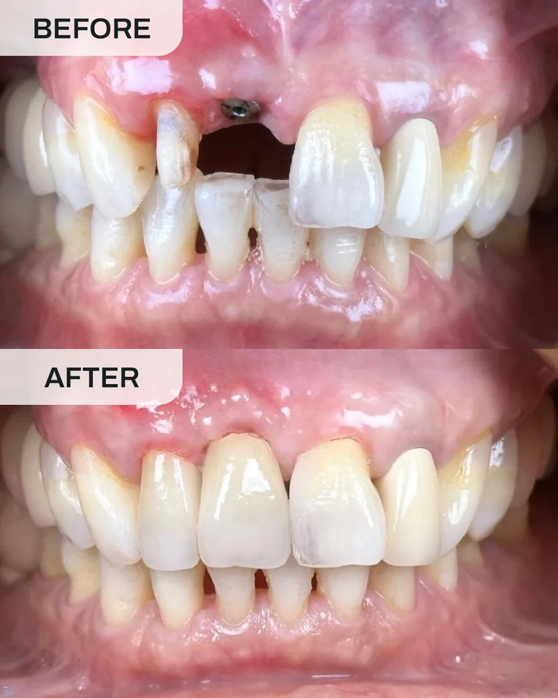牙科植体前后对比,案例6,Ivory Dental 甲洞