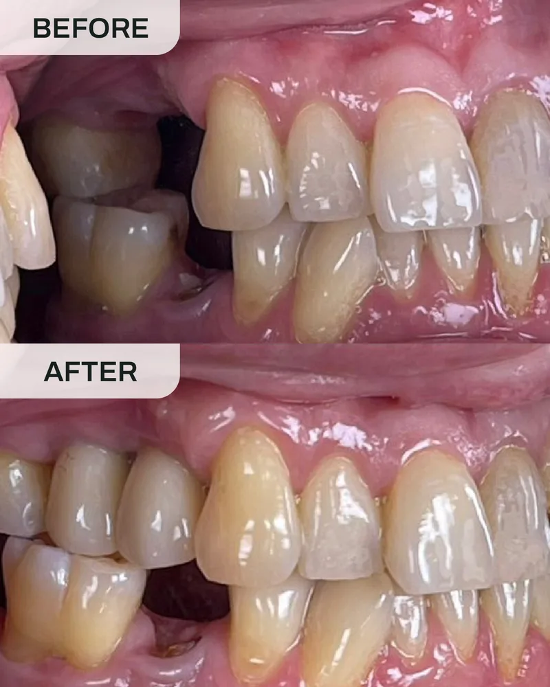 牙科植体前后对比,案例7,Ivory Dental 甲洞