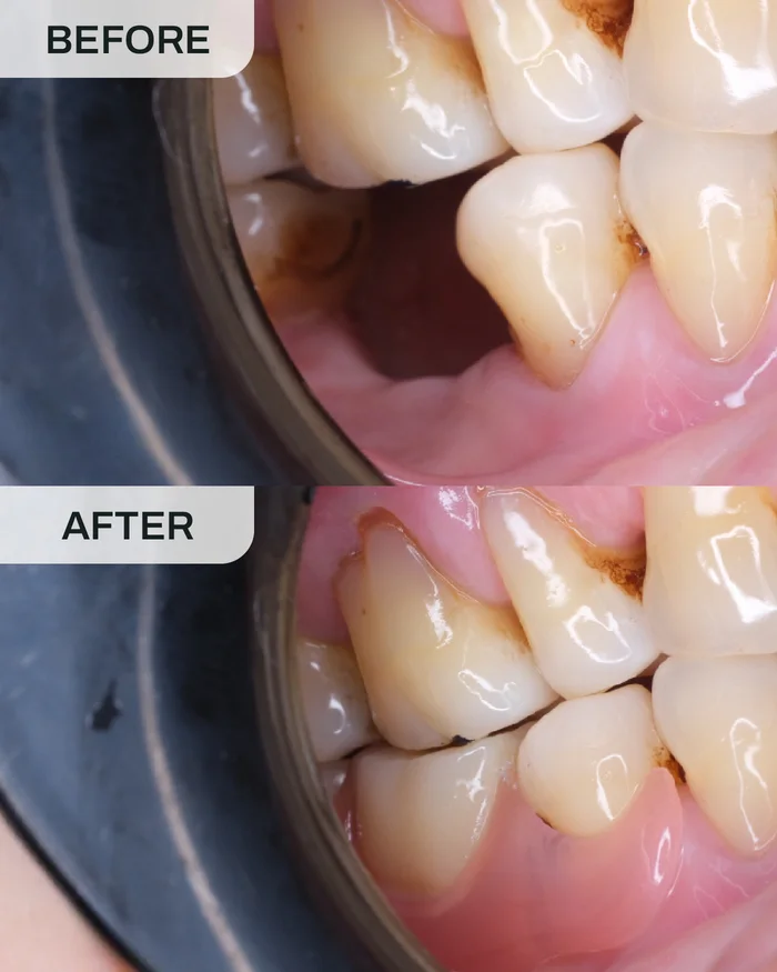 Gigi Palsu Flexi before and after result at Ivory Dental Kepong
