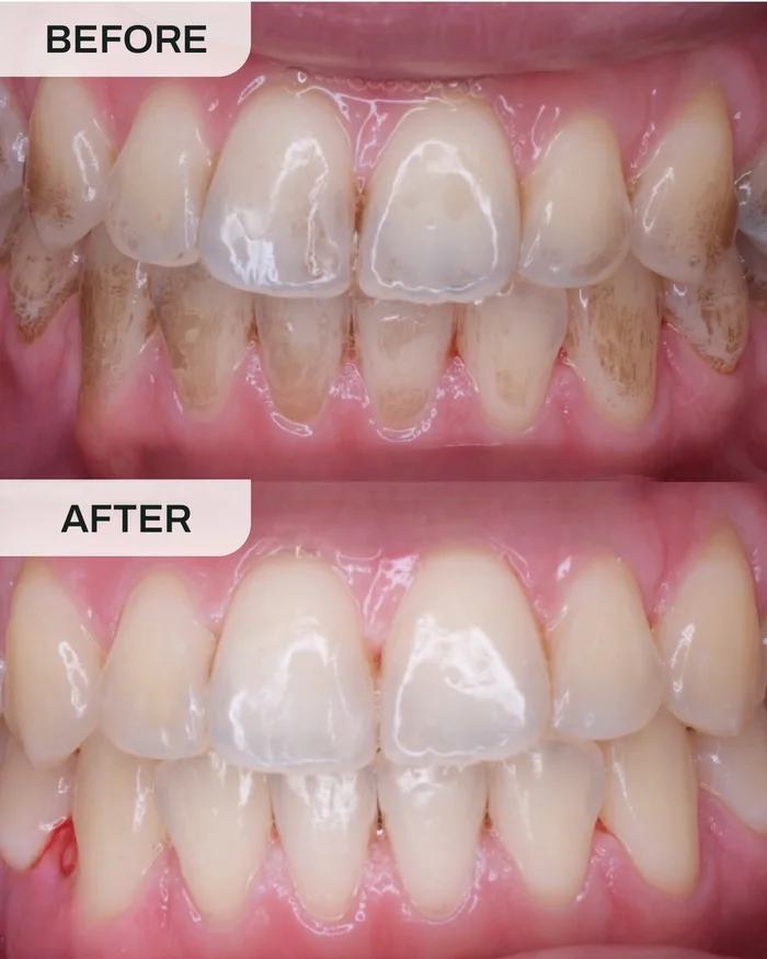 Skeling & Penggilapan before and after result at Ivory Dental Kepong