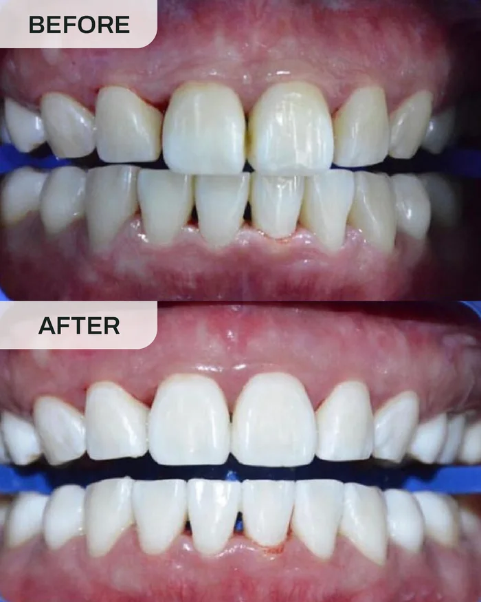 Pemutihan Gigi before and after result at Ivory Dental Kepong