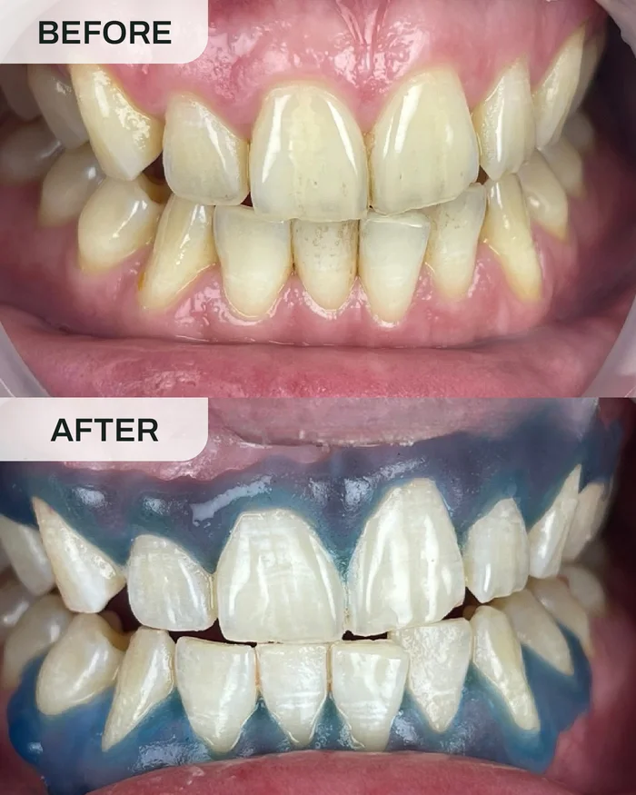 Pemutihan Gigi before and after result at Ivory Dental Kepong