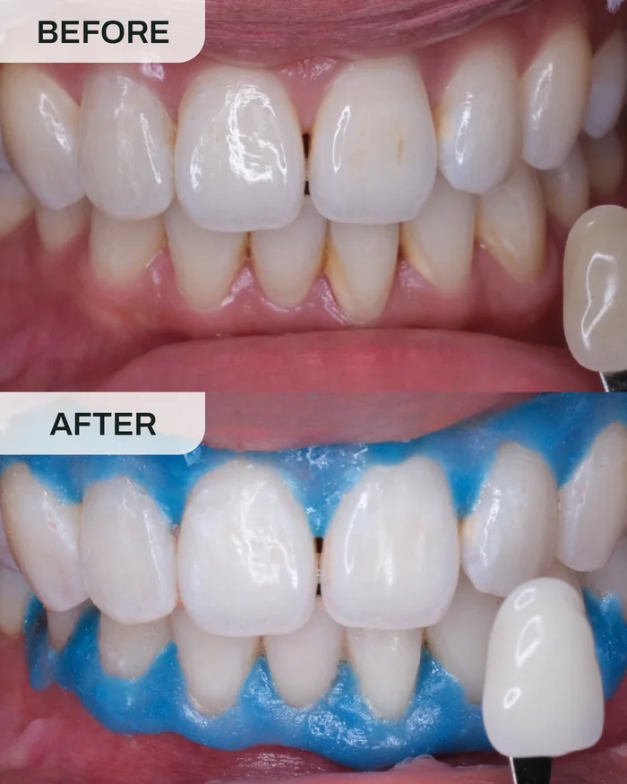 Pemutihan Gigi before and after result at Ivory Dental Kepong