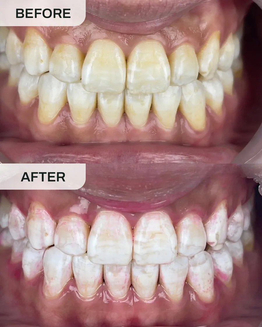 Pemutihan gigi sebelum dan selepas, kes 4, di Ivory Dental Kepong