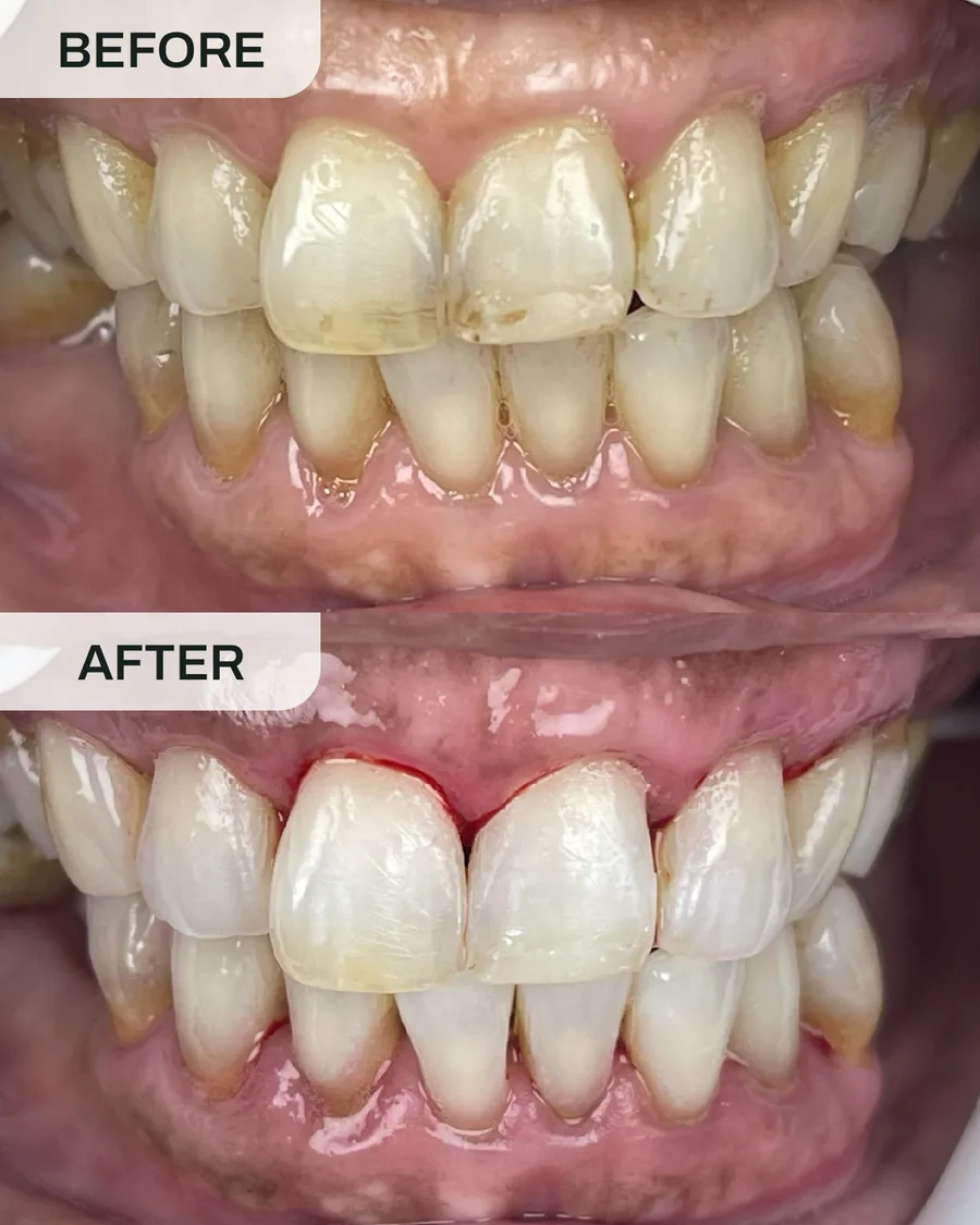 Pemutihan gigi sebelum dan selepas, kes 5, di Ivory Dental Kepong