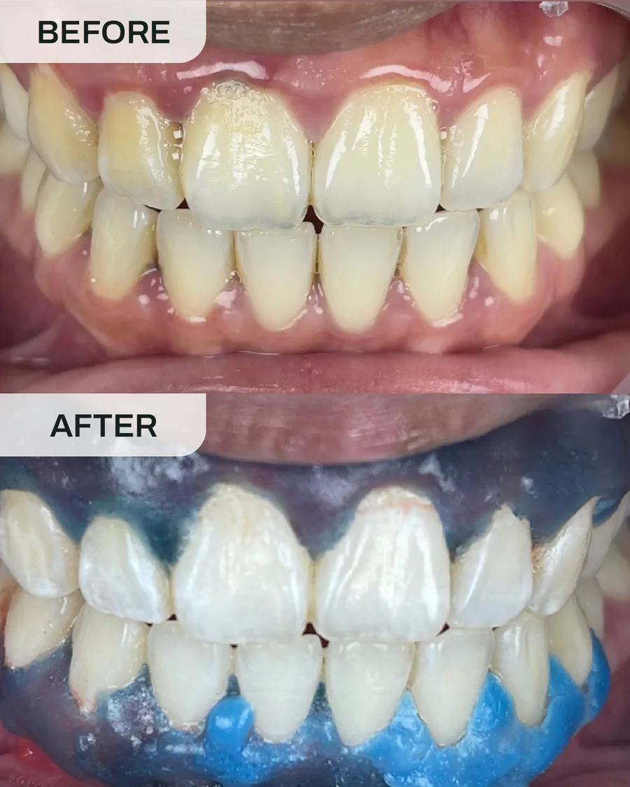 Pemutihan gigi sebelum dan selepas, kes 6, di Ivory Dental Kepong