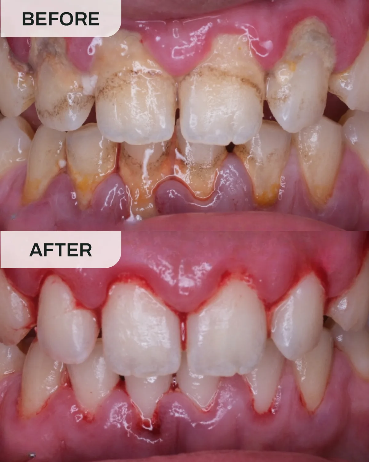 Hasil sebelum dan selepas rawatan gusi di Ivory Dental Kepong