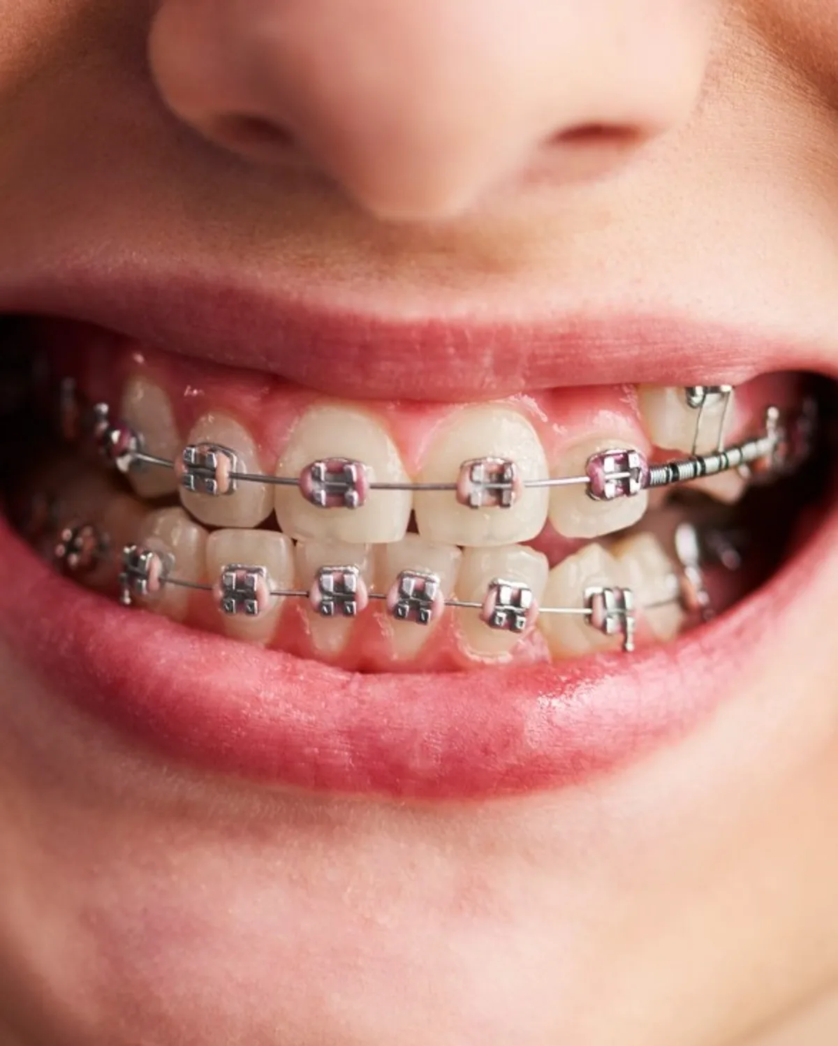 牙套特写，Ivory Dental 甲洞