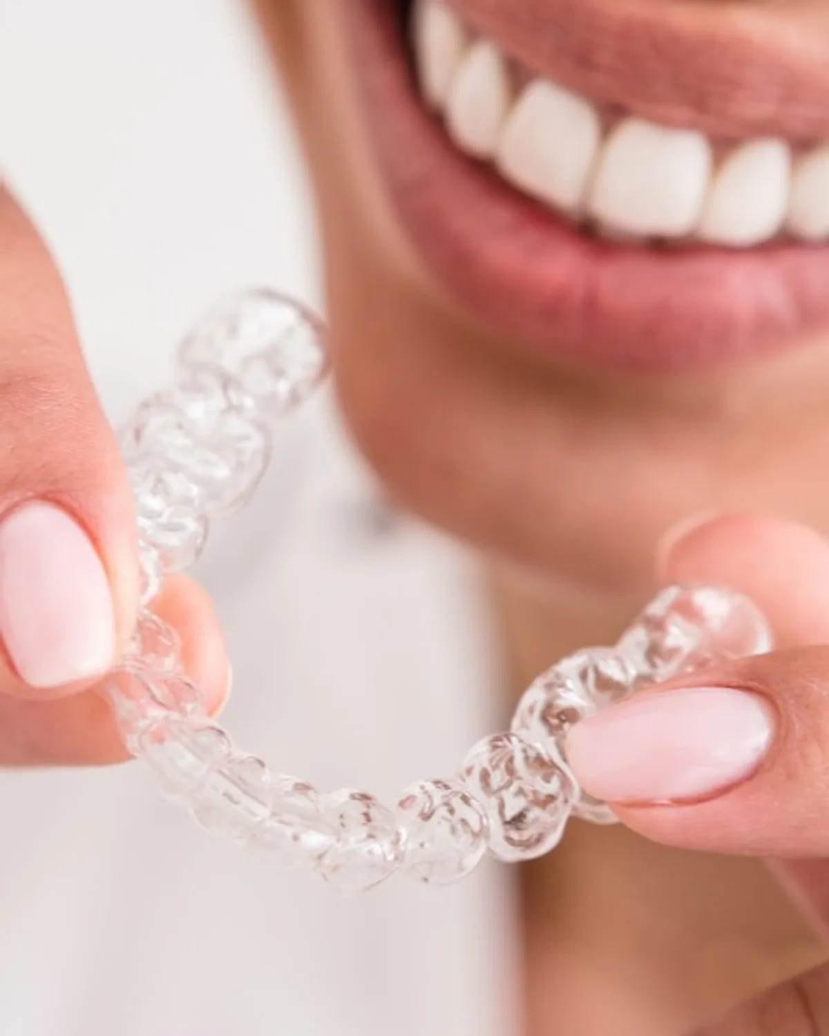 隐形牙套特写，病人微笑，Ivory Dental Kepong
