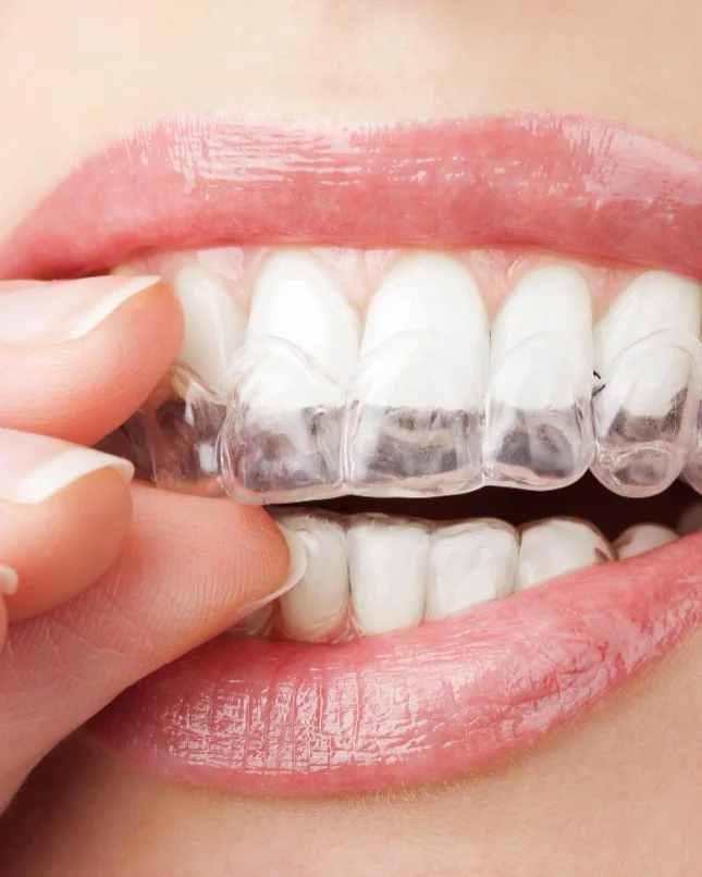 Pemasangan penjajar jernih di Ivory Dental Kepong