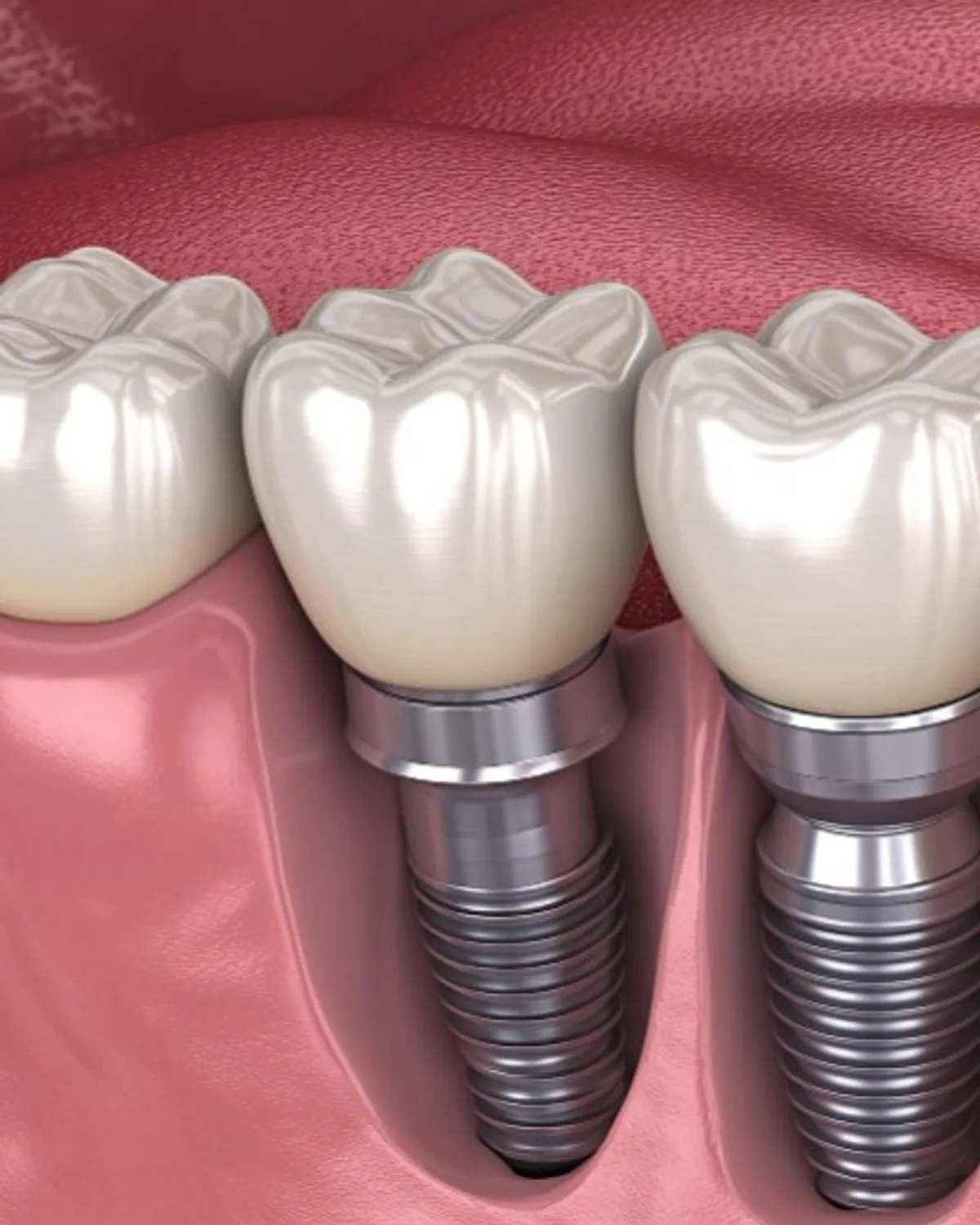 牙科植体3D示意图，Ivory Dental Kepong