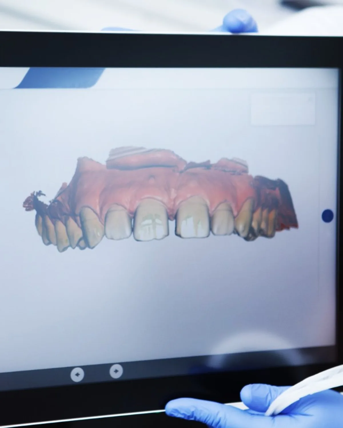数码X光检查影像，Ivory Dental 甲洞