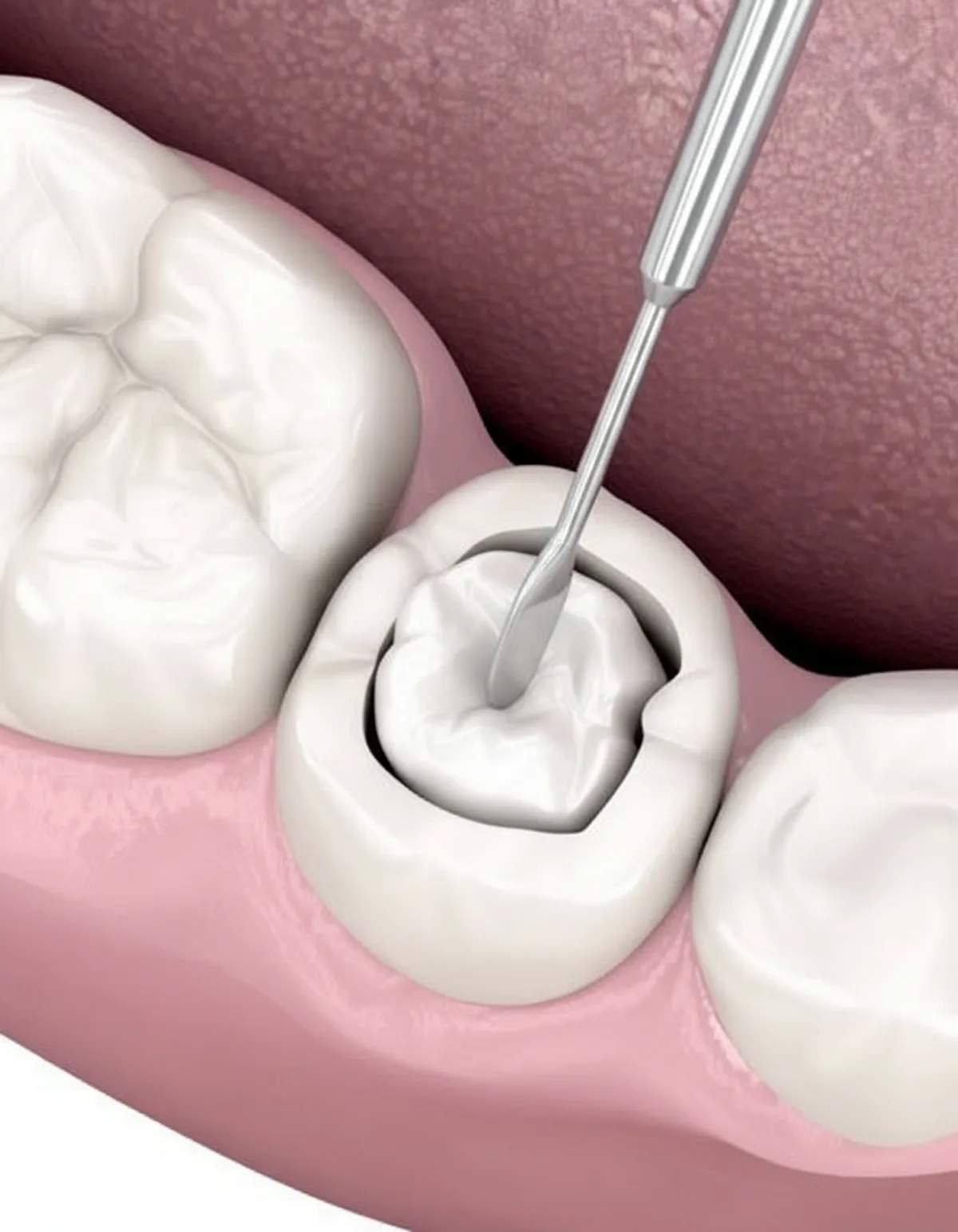 补牙填补示意图，Ivory Dental 甲洞
