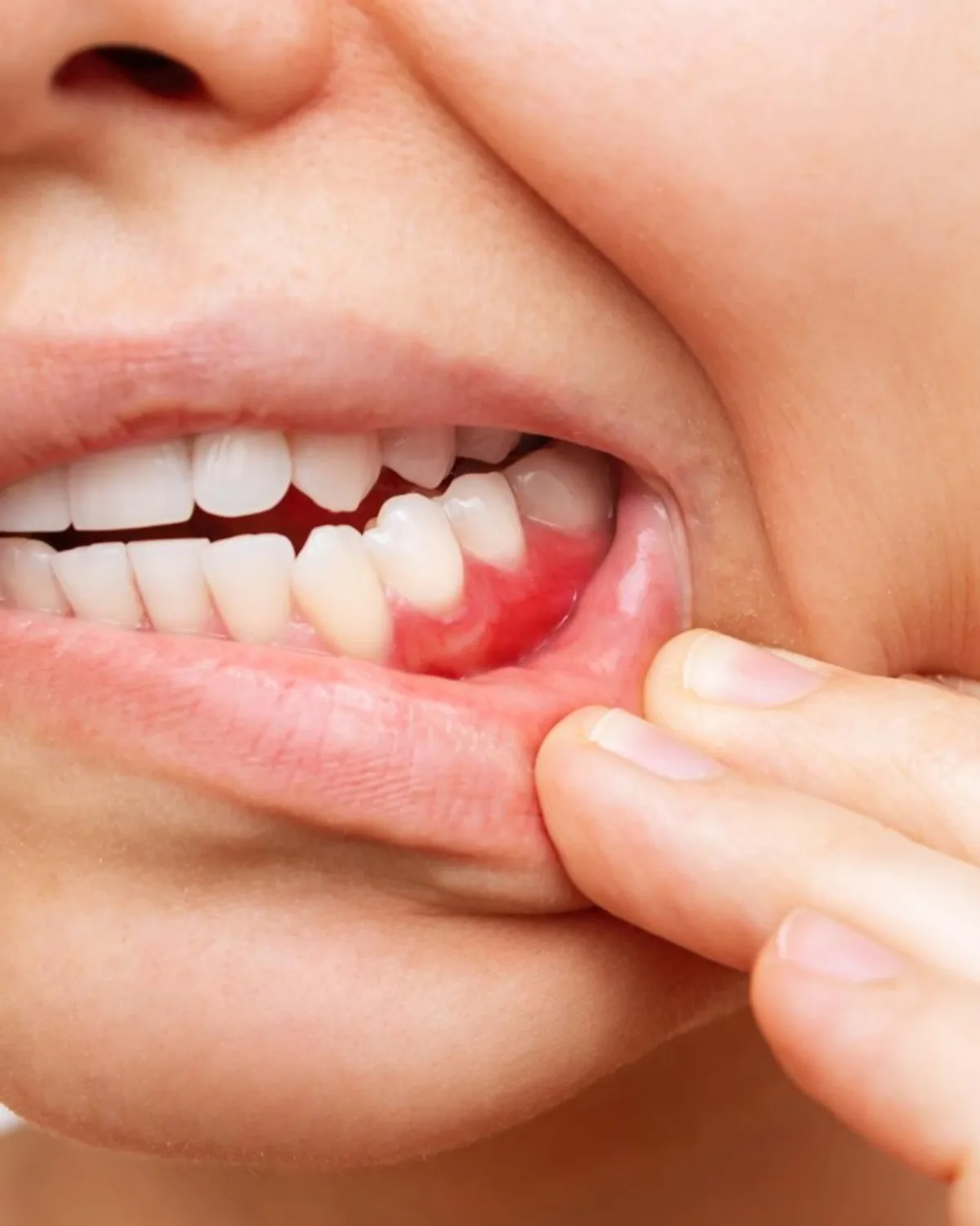 牙龈发炎治疗，Ivory Dental 甲洞