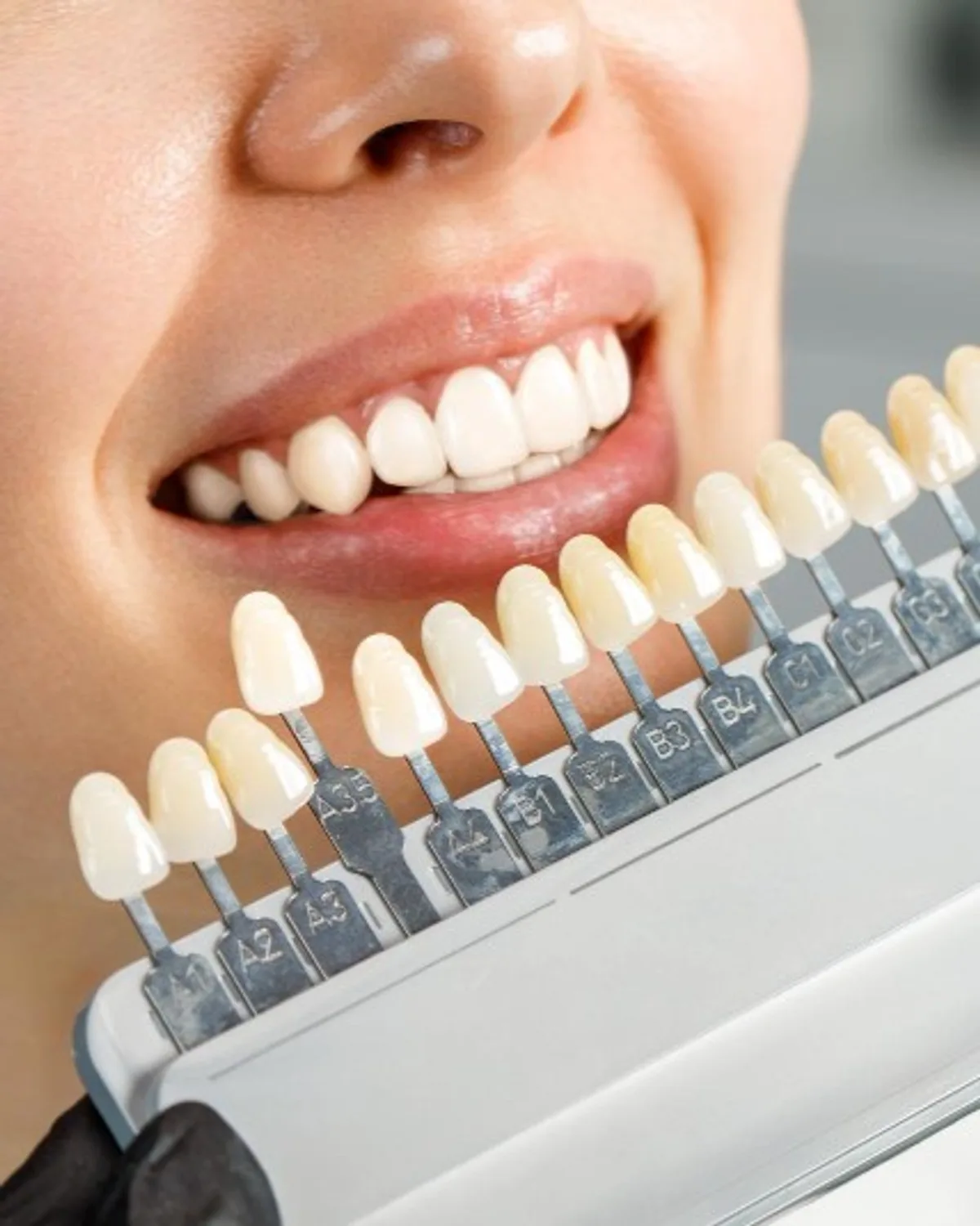 Pemadanan warna pemutihan gigi di Ivory Dental Kepong