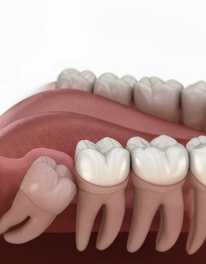 智齿拔除示意图，Ivory Dental 甲洞